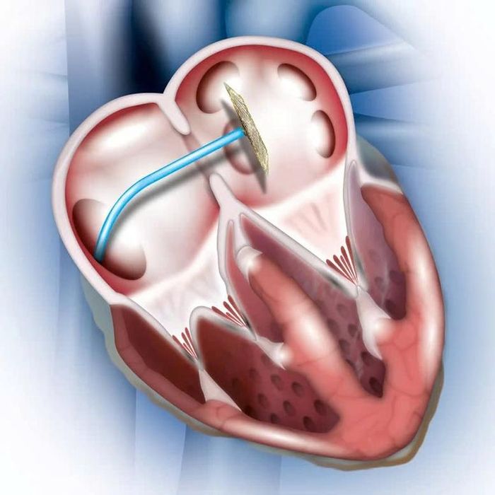 Thông liên nhĩ là một trong những dị tật tim bẩm sinh phổ biến, trong đó tồn tại lỗ thông bất thường giữa hai buồng nhĩ của tim.