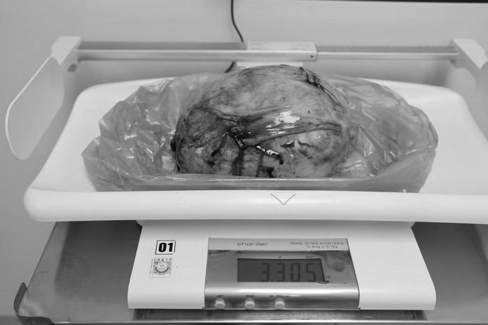 Khối u “khổng lồ” nặng 3.3kg được lấy ra khỏi cơ thể người bệnh - Ảnh BVCC