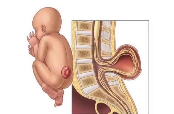 Hình ảnh mô tả dị tật thoát vị màng não tủy ở bệnh nhi - Ảnh BVCC