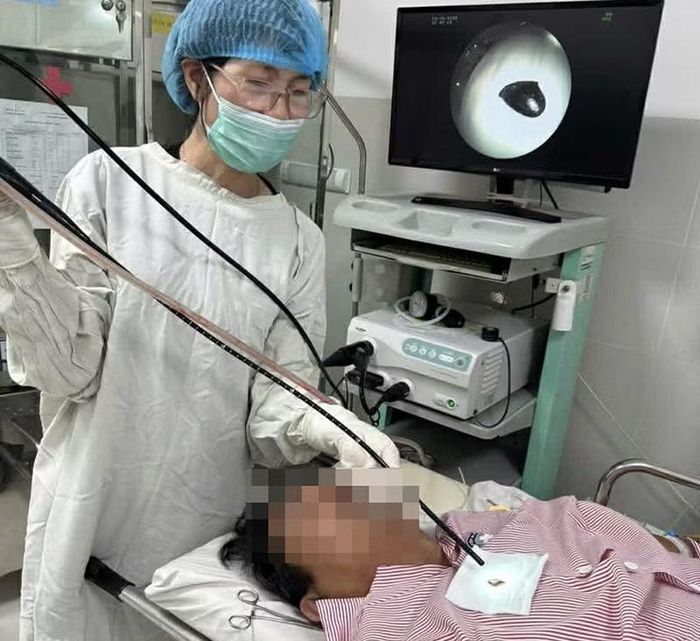 Bác sĩ đang nội soi, lấy hạt sapoche ra khỏi phế quản bệnh nhân.