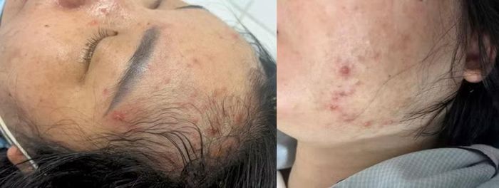 Các mụn nước thủy đậu rải rác vùng mặt - Ảnh BVCC