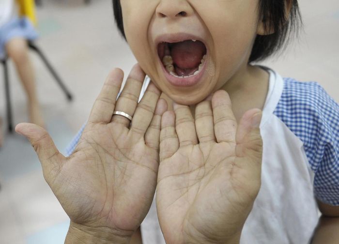 Kháng thể của bệnh nhân từ lần nhiễm B5 giảm khả năng bảo vệ trước C1, khiến cả những trẻ từng mắc bệnh vẫn có nguy cơ tái nhiễm biến chủng mới.
