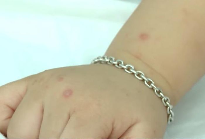 Ca mắc tay chân miệng chủ yếu xảy ra ở nhóm trẻ từ 1 đến 5 tuổi đang học tại các cơ sở mầm non, mẫu giáo.