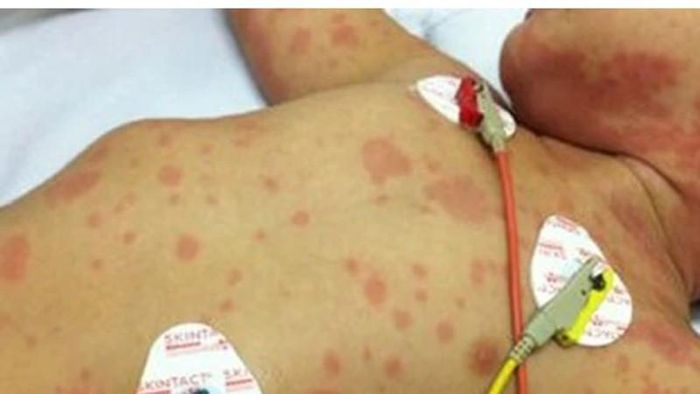 Trẻ em mắc viêm não mô cầu rất nguy hiểm về nguy cơ biến chứng