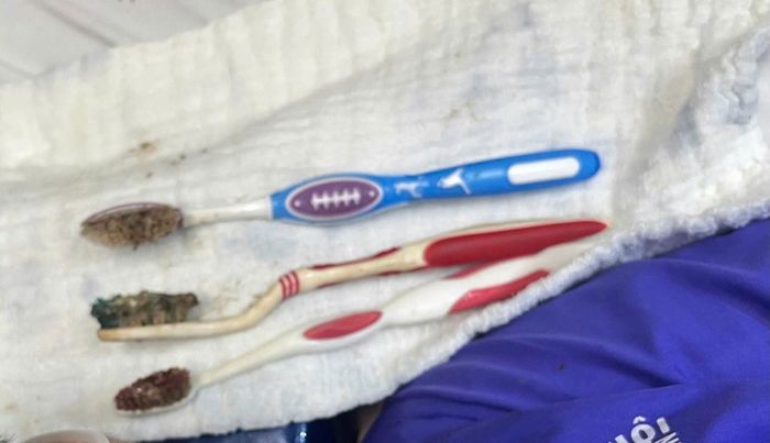 3 bàn chải đánh răng được lấy ra từ đường tiêu hóa bằng nội soi can thiệp