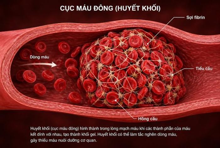 Hình ảnh cục máu đông (huyết khối).