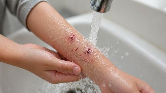 Cần rửa sạch vết thương ngay sau khi bị chó cắn để giảm nguy cơ lây nhiễm