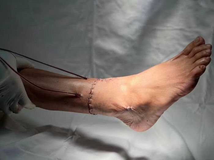 Bàn chân đứt lìa của bệnh nhân đã được nối lại