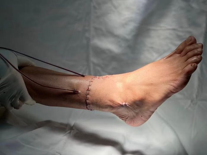 Bàn chân bị đứt lìa sau hơn 3 giờ đồng hồ được nối lại thành công.