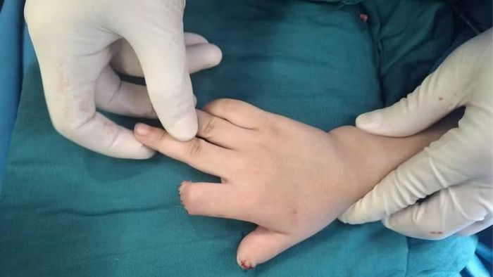 Tai nạn kinh hoàng từ xe điện tự chế khiến cháu bé mất 2 ngón tay
