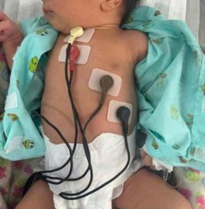 Bệnh nhi được chuyển tới khoa Sơ sinh để theo dõi, tìm nguyên nhân và điều trị. Ảnh: BVCC.