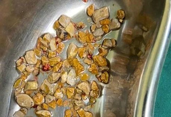  Thời tiết oi bức khiến nước tiểu dễ bị cô đặc, tạo điều kiện hình thành sỏi thận. Ảnh: Aware Gleneagles. 