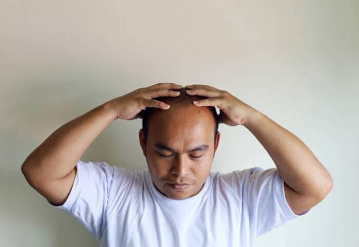 Người châu Á có tỷ lệ bị hói ít hơn người châu Âu. (Ảnh: iStock)