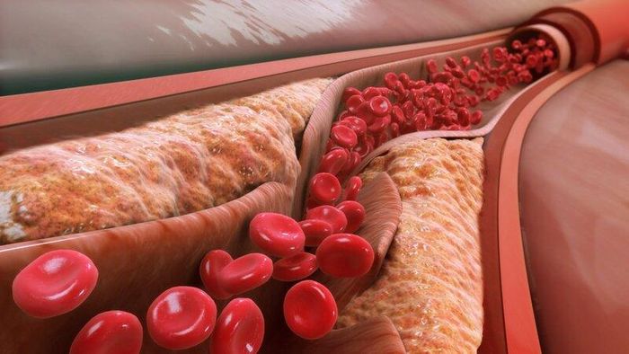 Trứng là một phần của chế độ ăn lành mạnh, tuy nhiên người có rối loạn lipid máu đã được chẩn đoán nên trao đổi với bác sĩ hoặc chuyên gia dinh dưỡng