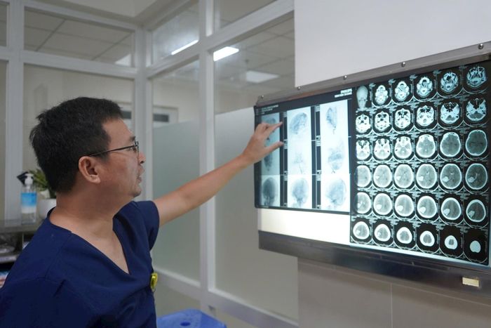 Hình ảnh dị dạng mạch máu não của bệnh nhân bị đột quỵ. Ảnh: B.V