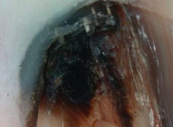  Melanoma trên Dermoscopy không đồng đều sắc tố, bờ không rõ, bản móng biến dạng. Ảnh: BSCC. 