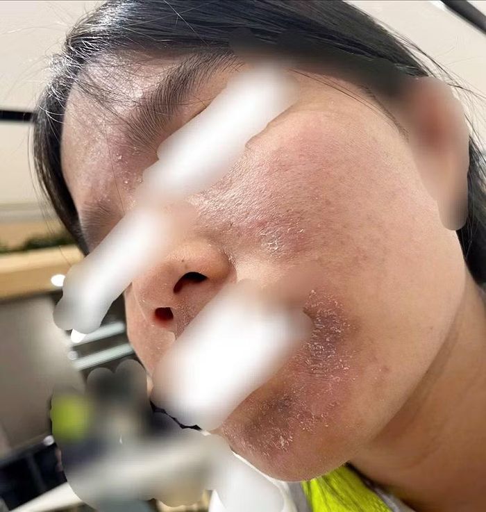 Mặt “nở hoa” khi dùng phải các loại mỹ phẩm không rõ nguồn gốc.