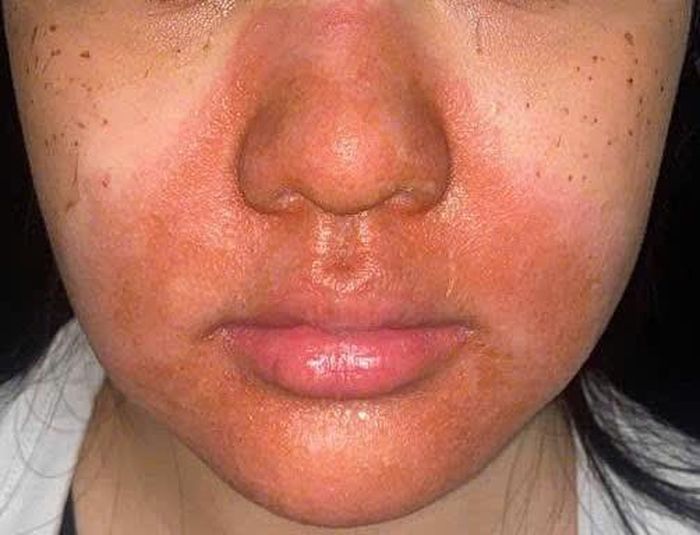 Tổn thương trên da bệnh nhân sau khi peel da tại cơ sở spa.