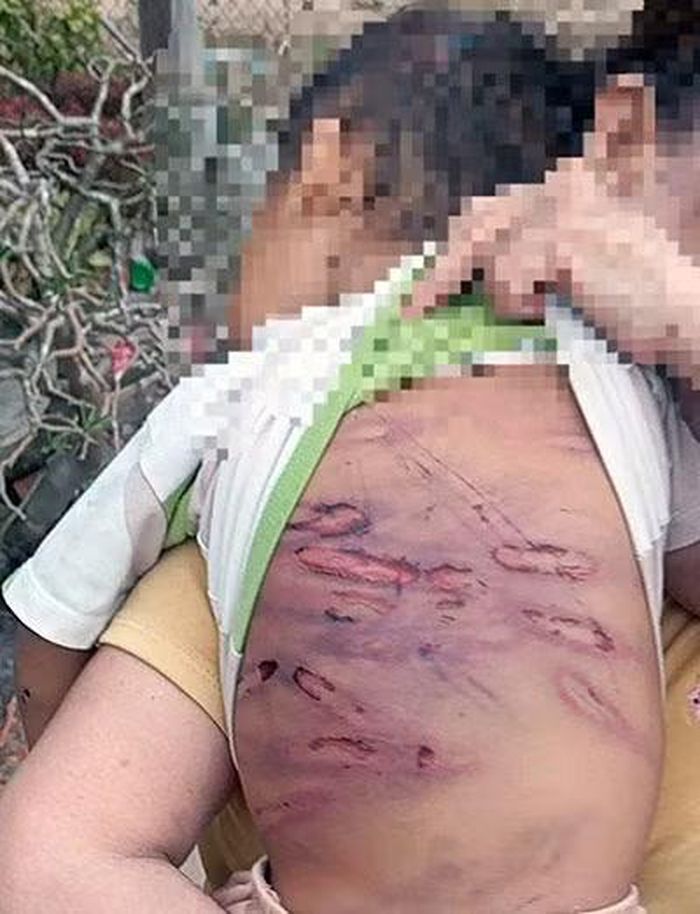 Bé trai mới hơn 2 tuổi bị mẹ ruột Nguyễn Thị Thanh Trúc và người tình là Danh Chơn bạo hành đến mức hôn mê.