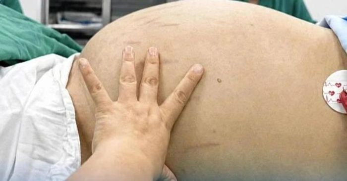 Khối u khổng lồ khiến bụng cô gái to như mang bầu 9 tháng. Ảnh: Bệnh viện cung cấp.