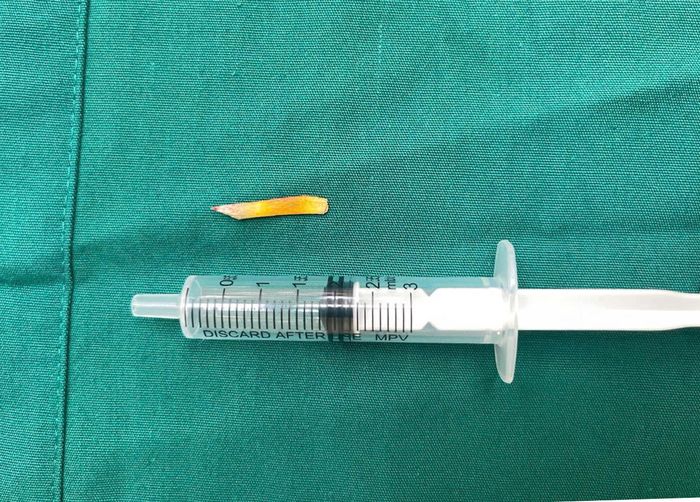 Dị vật sắc nhọn đã được các bác sĩ gắp ra ngoài. Ảnh: BV