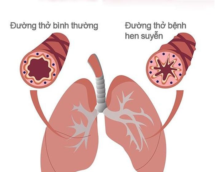 Hen suyễn là bệnh mạn tính đường thở (phế quản) do viêm, co thắt và tăng tính phản ứng đường thở, gây ra các triệu chứng ho, khò khè, tức ngực, khó thở tái phát.