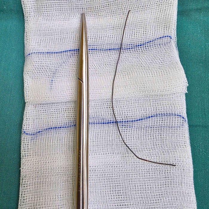 Cọng kẽm 18cm ở trong phổi người phụ nữ.