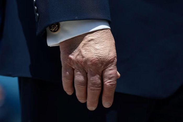 Lớp trang điểm trên mu bàn tay của Tổng thống Mỹ Trump, dường như là để che vết bầm tím. (Ảnh: Reuters)