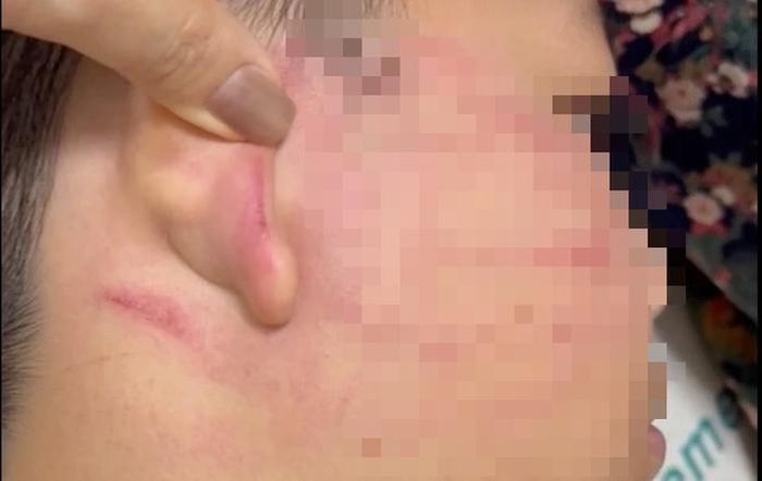 Học sinh lớp 4 bị thầy giáo Ấn Độ tát thủng màng nhĩ