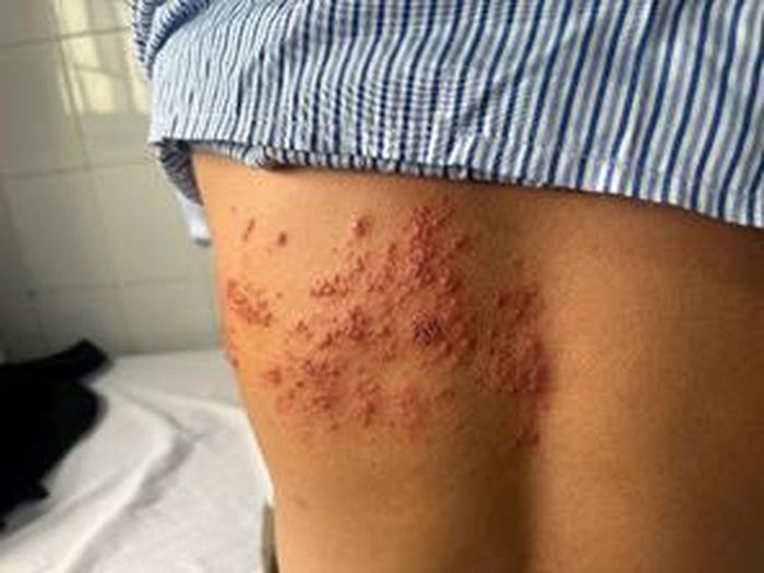 Các nốt mụn zona lan khắp mạn sườn bệnh nhân T gây đau giật từng cơn. Ảnh: BVCC.