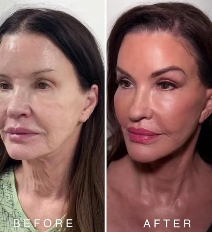 Hình ảnh trước và sau ca phẫu thuật thẩm mỹ của Janice Dickinson ở tuổi ngoài 70.
