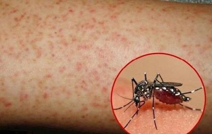 Hơn 1.100 người mắc sốt xuất huyết, Lâm Đồng kích hoạt các biện pháp phòng, chống dịch. Ảnh minh họa.