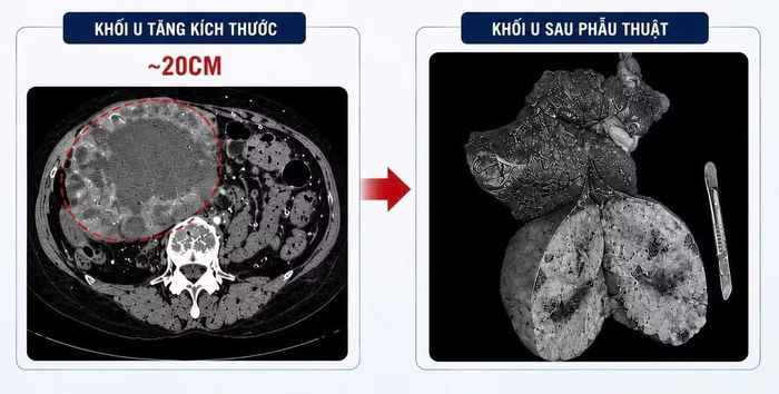 Khối u gan khổng lồ trên phim và sau phẫu thuật - Ảnh BVCC