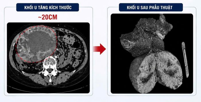 Khối u gan "khủng"