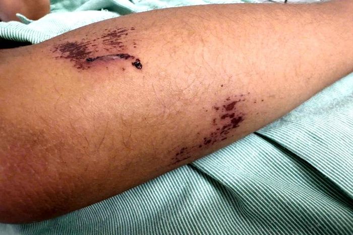 Nhóm thiếu niên truy đuổi khiến nam sinh ngã ra đường với nhiều vết thương. Ảnh: Đinh Đại