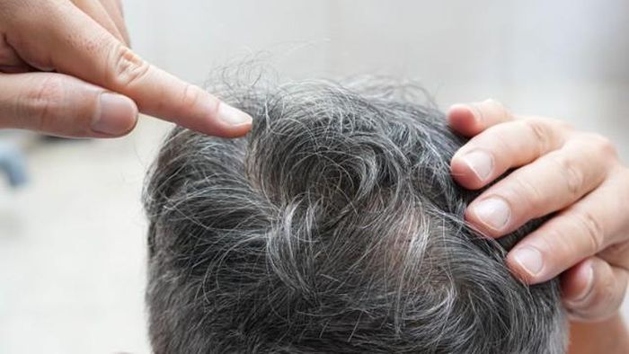 Tóc bạc sớm ngày càng phổ biến do căng thẳng, thiếu dinh dưỡng và lối sống thiếu khoa học.
