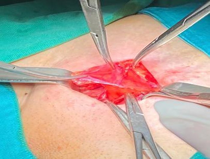 Túi thoát vị được bộc lộ trong quá trình phẫu thuật.