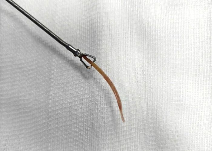 Hình ảnh dị vật là tăm tre được lấy ra khỏi đại tràng của bệnh nhân. Ảnh: BVCC.