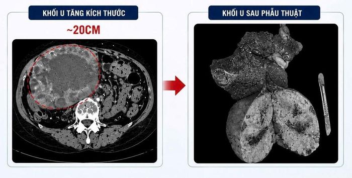 Khối u tăng từ 2cm lên 20cm