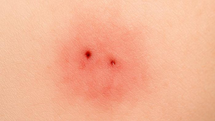 Hãy rửa thật nhẹ xung quanh vết rắn cắn (Ảnh minh họa)