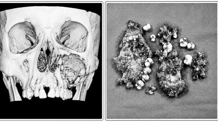 Phim chụp CT 3D vùng mặt cho thấy, cháu H.T.H bị tổn thương đa nang, gây tiêu xương, làm phồng vỏ xương hàm bên trái và khối u được lấy toàn bộ, gửi giải phẫu bệnh.