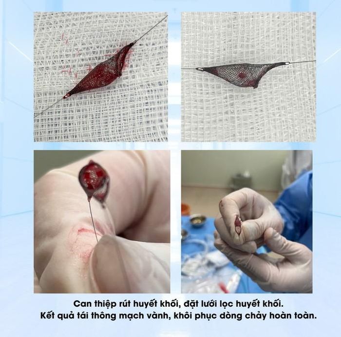 Bệnh nhân được kích hoạt quy trình cấp cứu tim mạch khẩn cấp