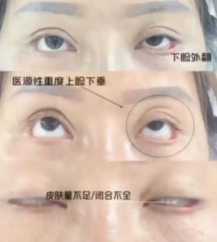 Ca phẫu thuật cắt mí hỏng đã khiến Wang phải sống nhiều năm trong tình trạng không thể khép kín mắt. Ảnh: News.china.com