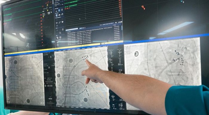 Ghi nhận từ 3 trường hợp đầu tiên được thực hiện tại Bệnh viện Thống Nhất cho thấy thủ thuật diễn ra thuận lợi, các bệnh nhân đều phục hồi tốt sau can thiệp.