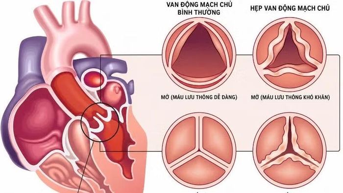 Hình ảnh giải phẫu van động mạch chủ.