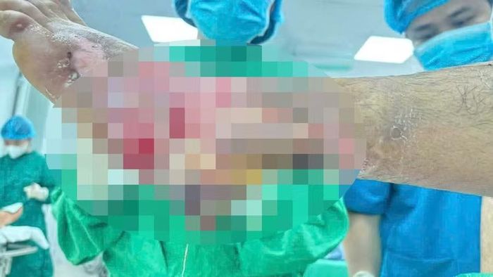 Phần chân của Giáp bị hoại tử nghiêm trọng có khả năng phải cắt bỏ.