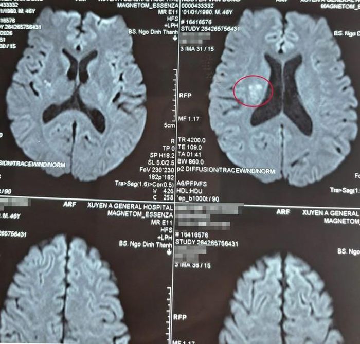 Hình ảnh MRI xác định vị trí tổn thương do đột quỵ nhồi máu não. Ảnh: BVCC
