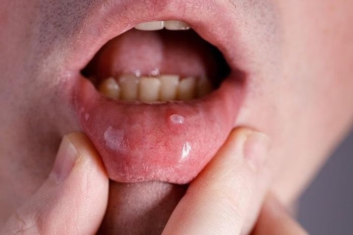  Không nên chủ quan với những vết loét miệng kéo dài vì có thể là nguy cơ ung thư cao. Ảnh: Shutterstock. 