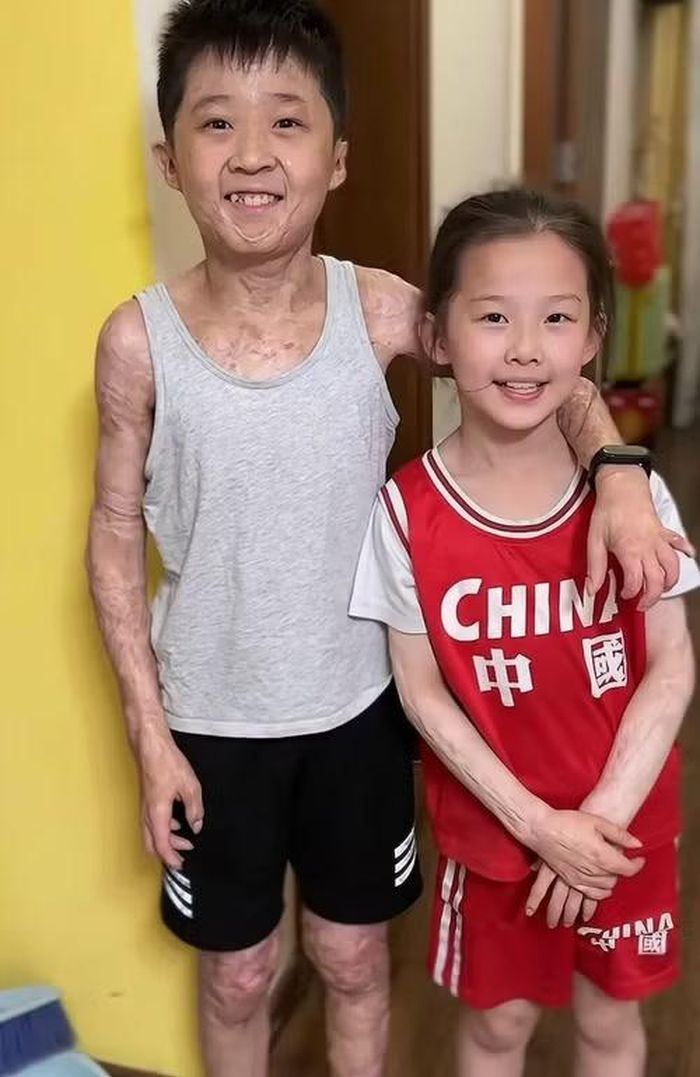 Xuanxuan và em gái bị bỏng sau vụ cháy tiệm mì gia đình.