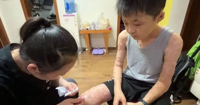 Cơ thể bỏng nặng khiến Xuanxuan chịu đau đớn khi tập cầu lông.